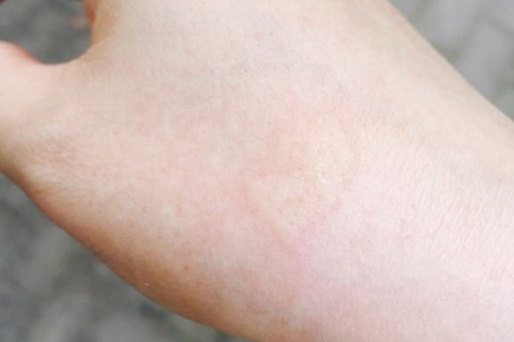 刺毛虫皮炎风团样皮疹图