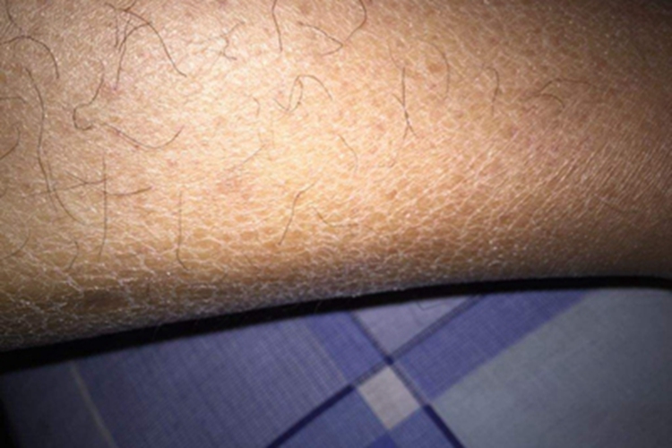 皮肤干燥症裂纹图 皮肤干燥症裂纹图