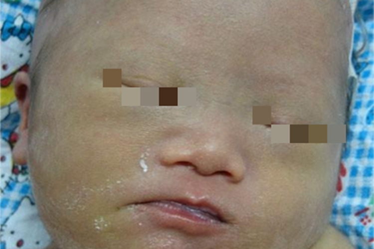 婴儿青铜综合征面部皮肤发黄图