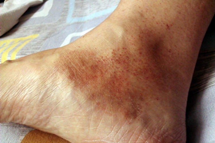 过敏性紫癜脚踝症状图