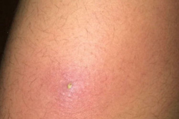 皮肤非典型分枝杆菌病脓包图