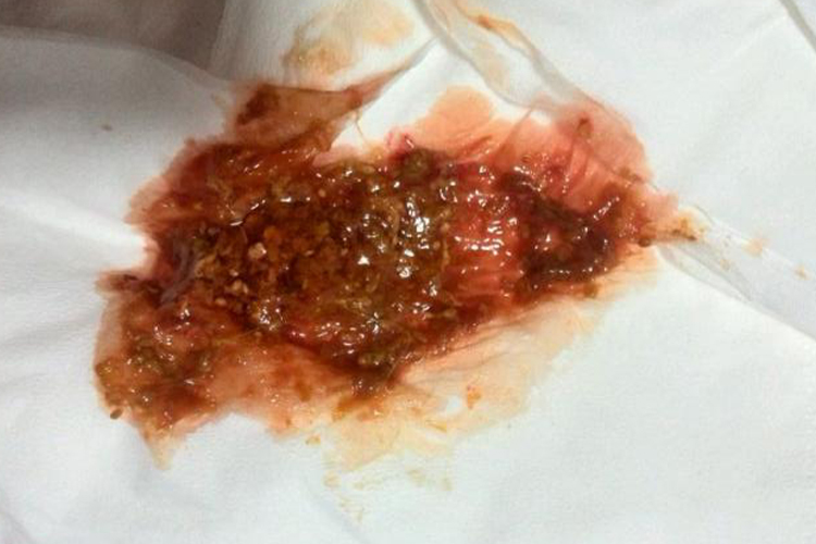 粪便带血、黏液图