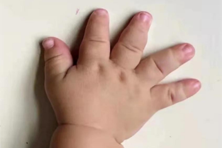 小儿软骨发育不全手指发育不良图 小儿软骨发育不全手指发育不良图