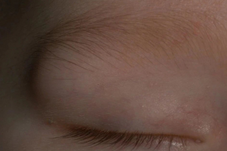 眼眶皮样囊肿大包图