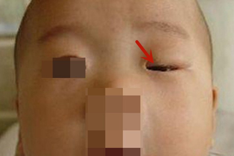 皮肌炎眼睑症状图