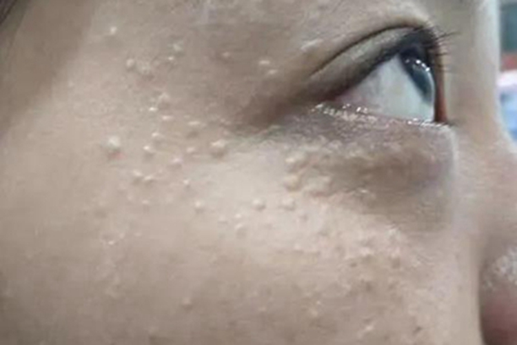 汗腺瘤眼周小疙瘩图