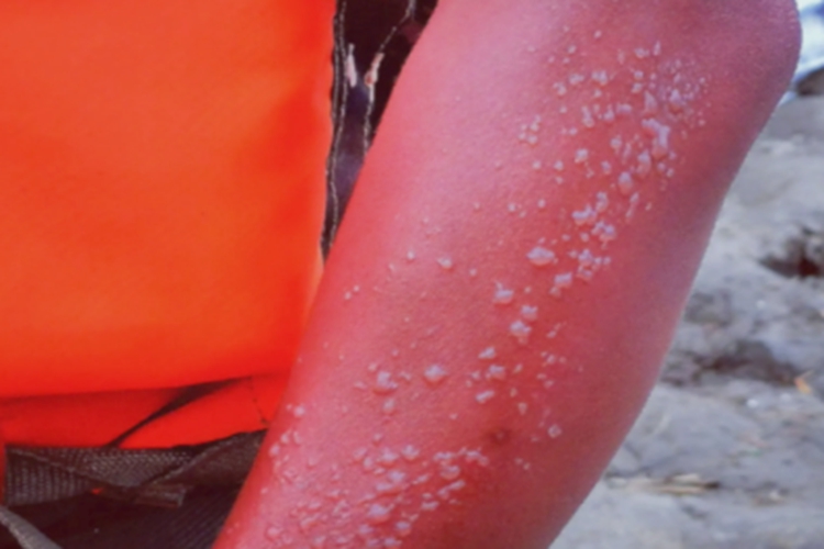 日照性皮炎胳膊水疱图