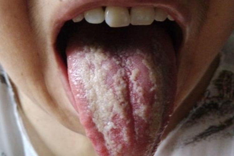 口腔梅毒舌头白斑图