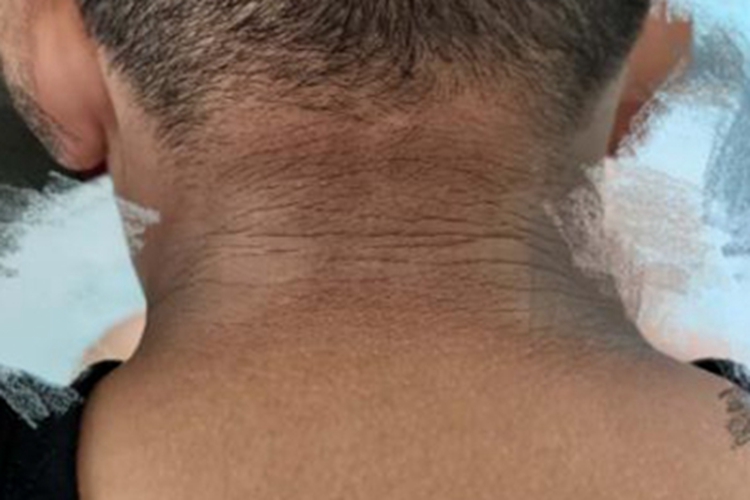 恶性黑棘皮病后颈皮肤发黑图