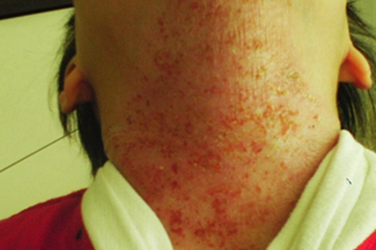 儿童期特应性皮炎溃疡图 儿童期特应性皮炎溃疡图