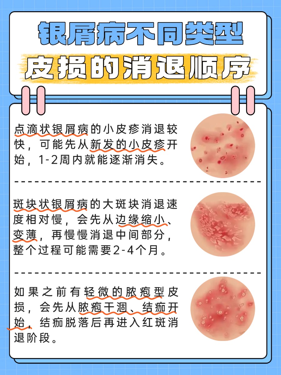 银屑病消退顺序，医生教你正确判断！