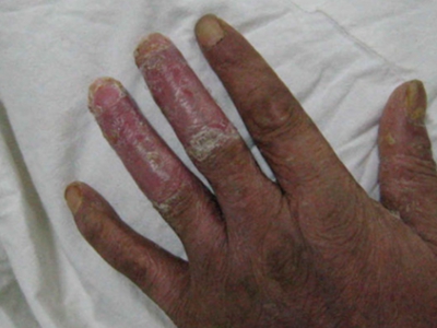 脓疱性肢端皮炎的症状和图片 - 有来医生