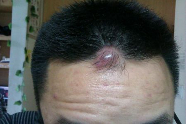 头部表皮囊肿图