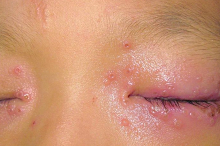 病毒性睑皮炎眼周小水疱图