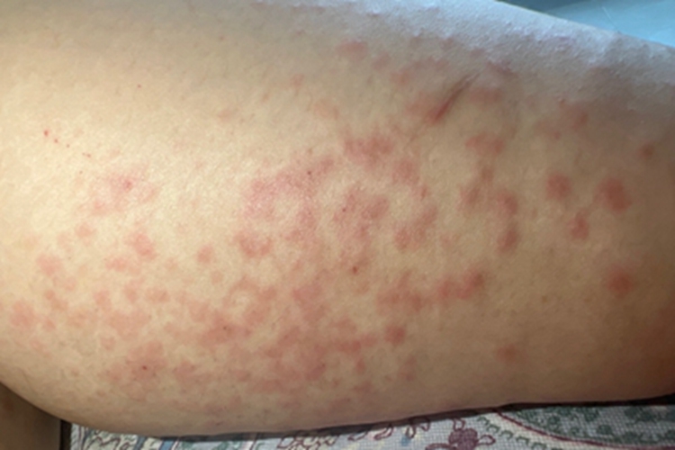 亚急性接触性皮炎小腿红斑图