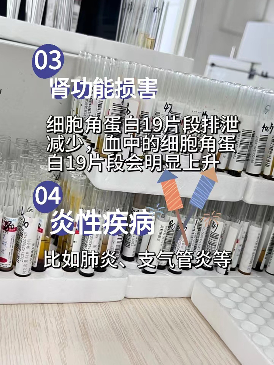 告诉你细胞角蛋白19片段偏高的真实原因！