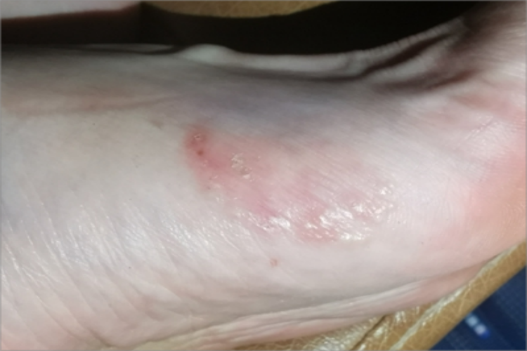 足癣脚部糜烂图