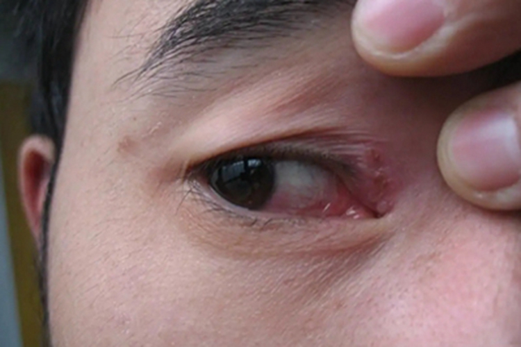 眼睑单纯性疱疹眼角结痂图 眼睑单纯性疱疹眼角结痂图