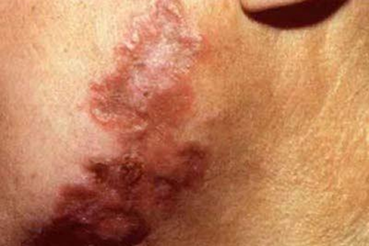 瘰疬性皮肤结核面部瘢痕图