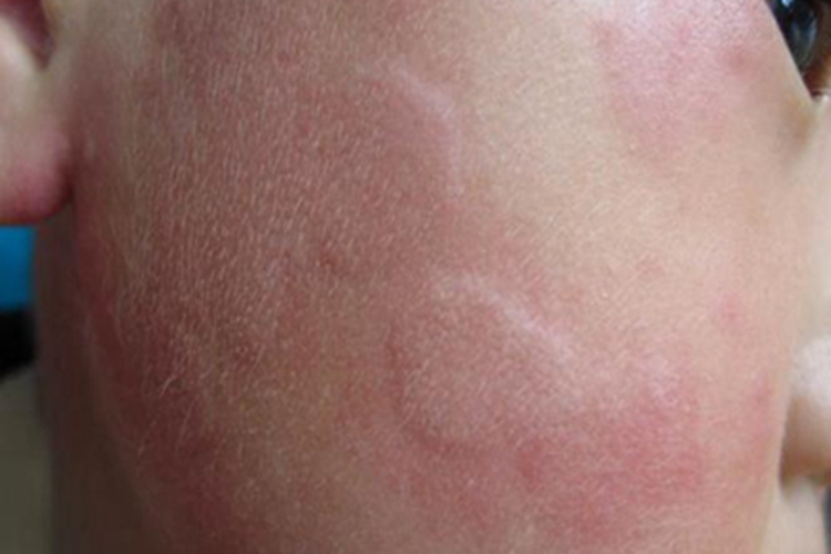 冷接触性荨麻疹面部风团图 冷接触性荨麻疹面部风团图