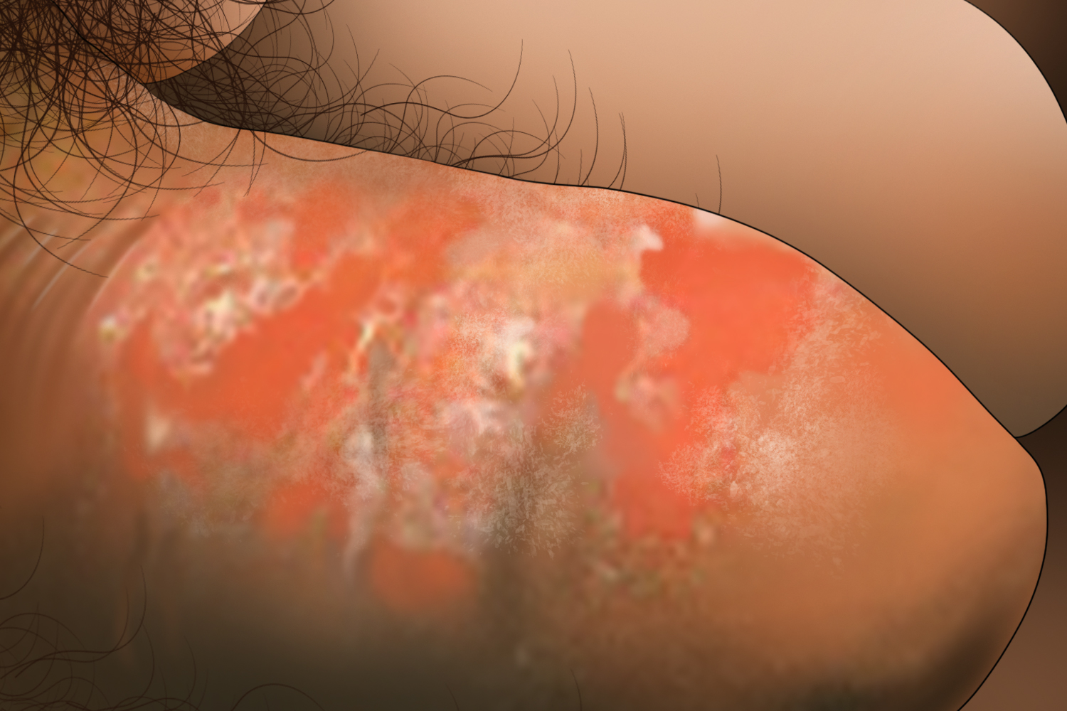 念珠菌病龟头手绘图