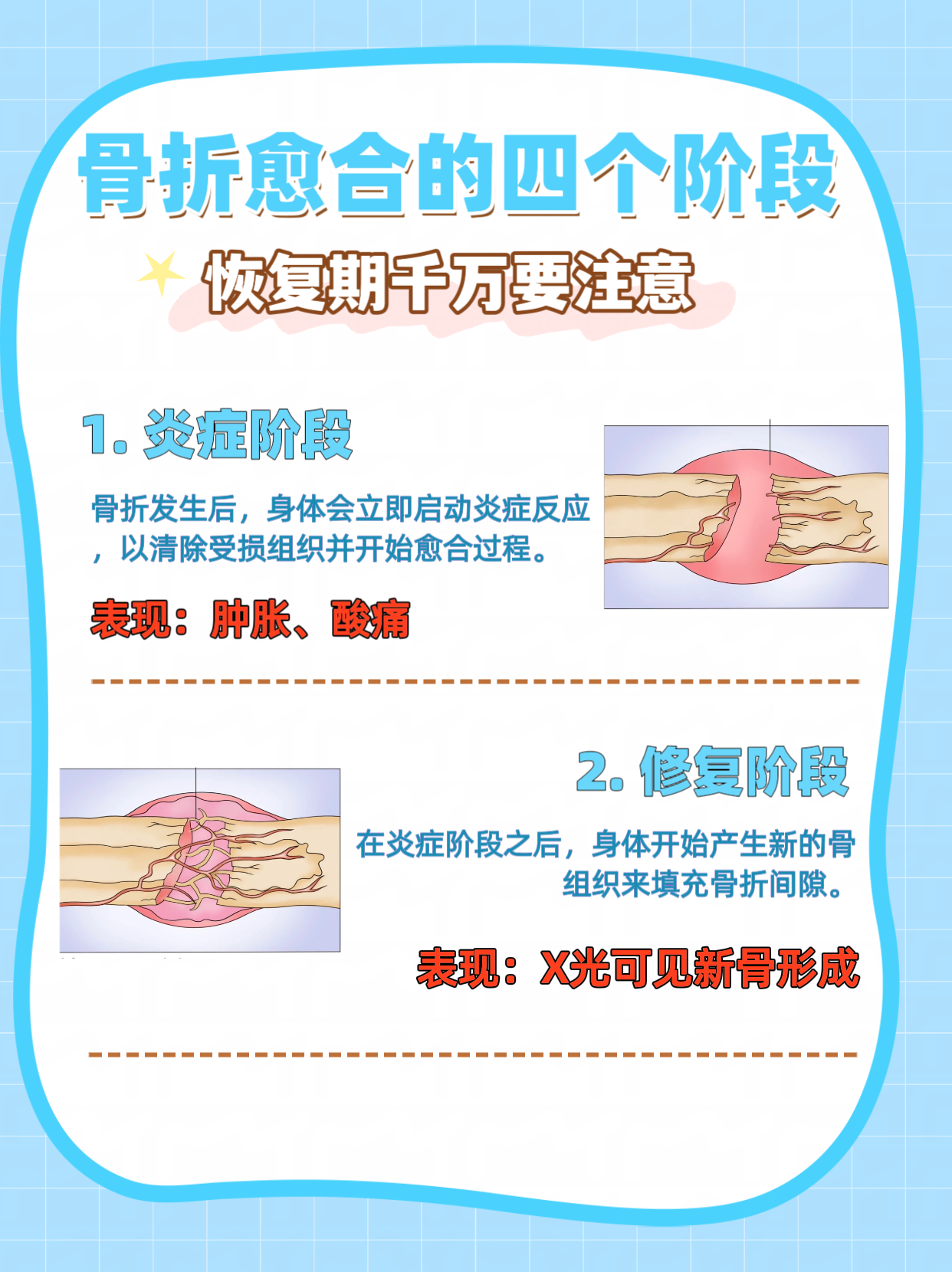 骨折愈合之旅：图解大全带你了解每一步