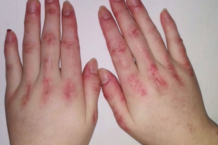 手部指关节紫红色丘疹图