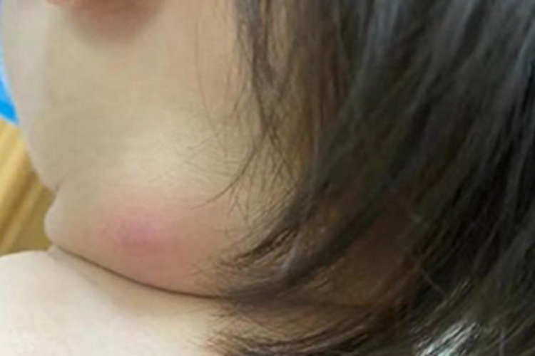 婴幼儿化脓性淋巴结炎侧颈肿块图