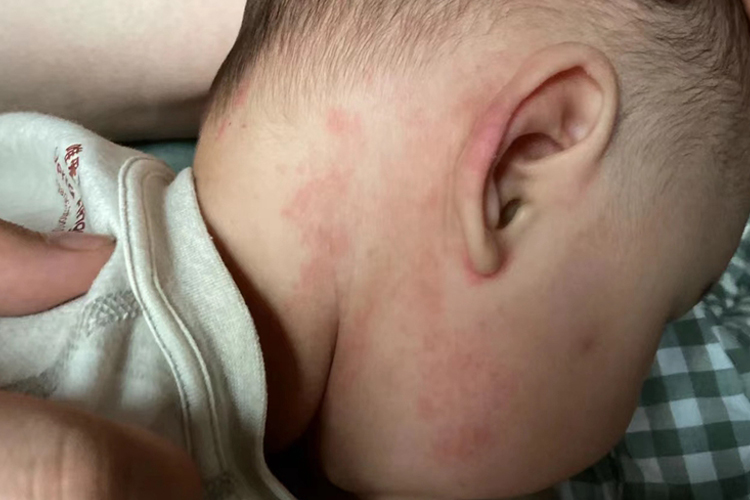 打完麻腮风疫苗后红疹图