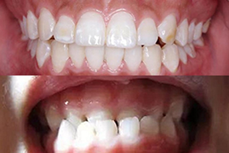 牙齿深覆颌的对比图