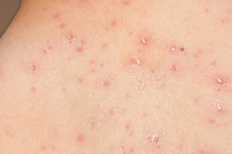 水痘初期丘疹图