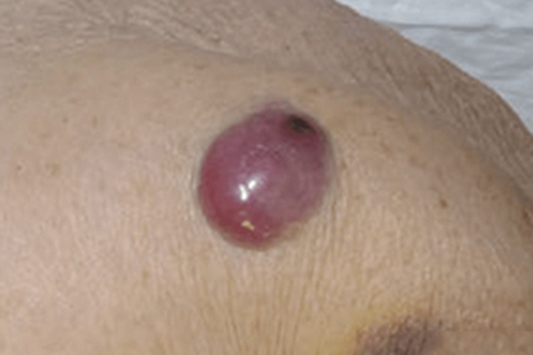 Merkel细胞癌腰部圆疙瘩图