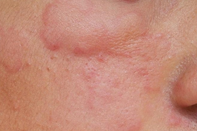 荨麻疹型化妆品皮炎面部症状图