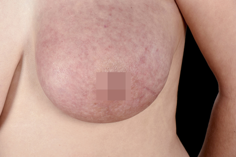 炎性乳腺癌皮肤发红肿胀图