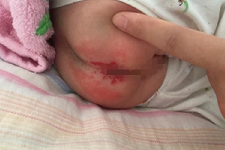 婴儿尿布疹红斑图