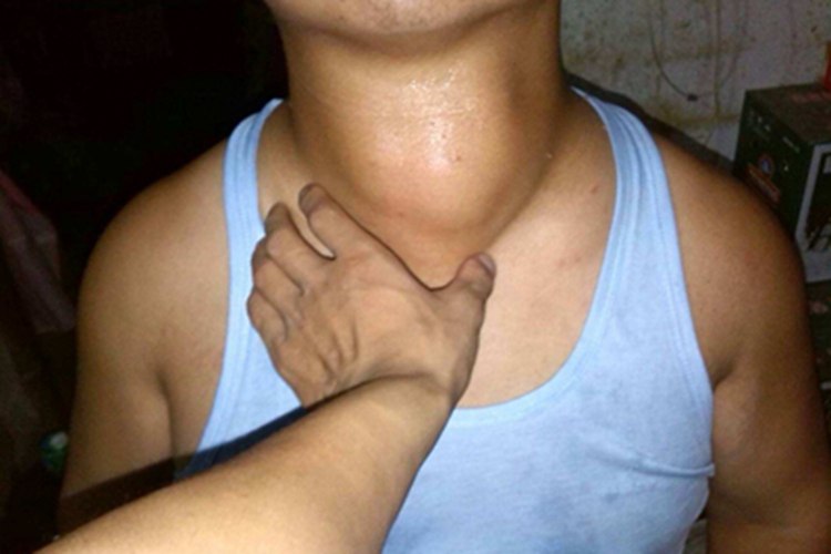 甲状腺腺瘤颈部结节图 甲状腺腺瘤颈部结节图