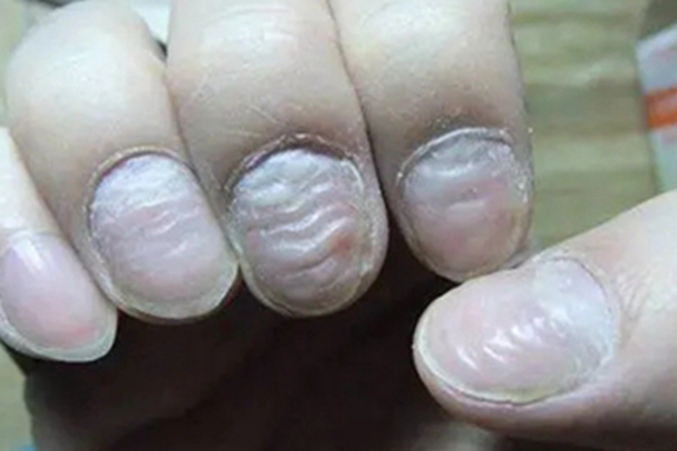 皮肤基底细胞癌手指甲有坑图