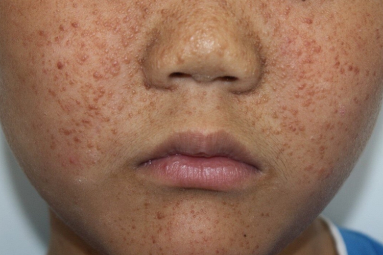 血管纤维瘤图 血管纤维瘤图