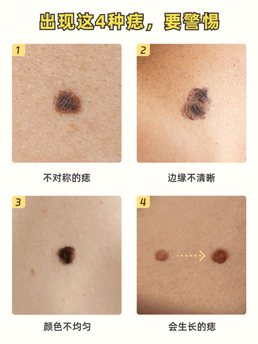 杭州切痣攻略:从术前准备到术后护理的保姆级指南