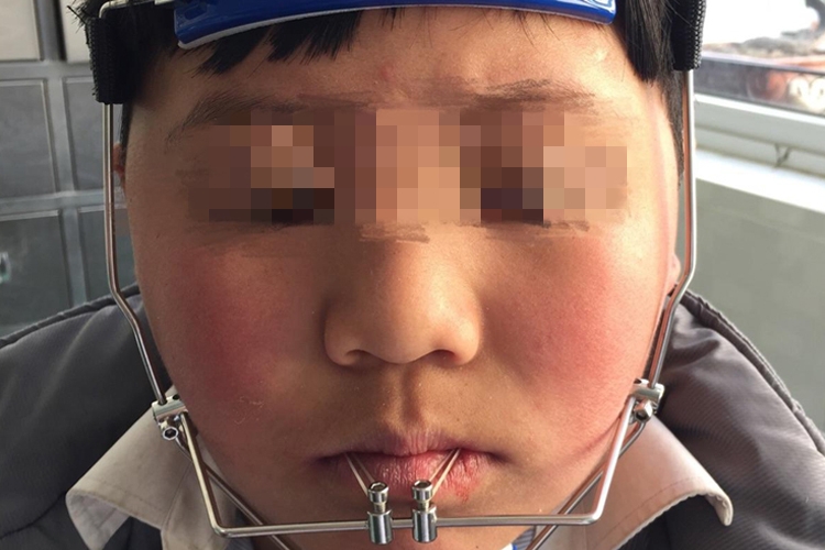 前方牵引器使用图