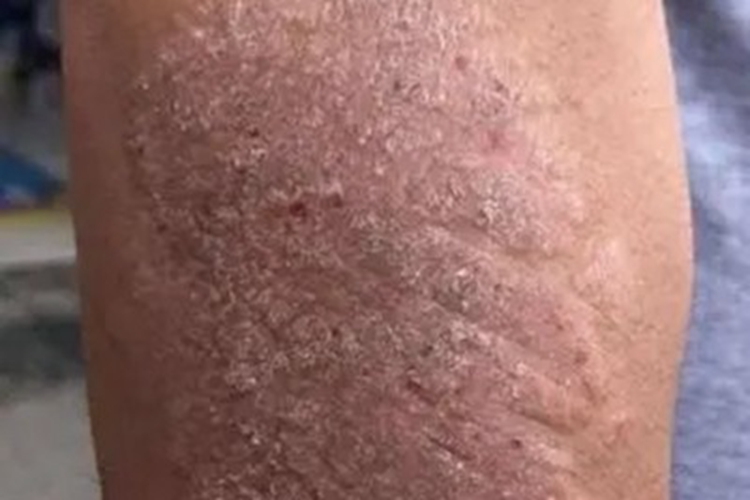 慢性苔藓样角化病小腿圆疙瘩图