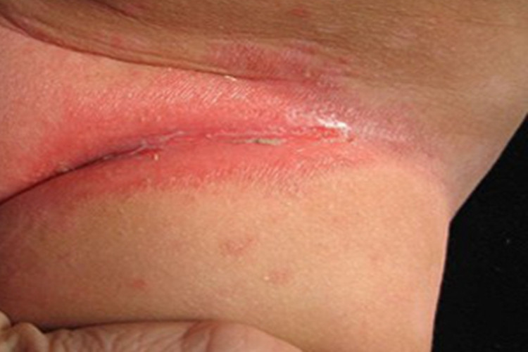 间擦疹大腿糜烂图