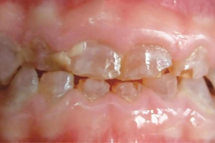 牙本质发育不全图 牙本质发育不全图