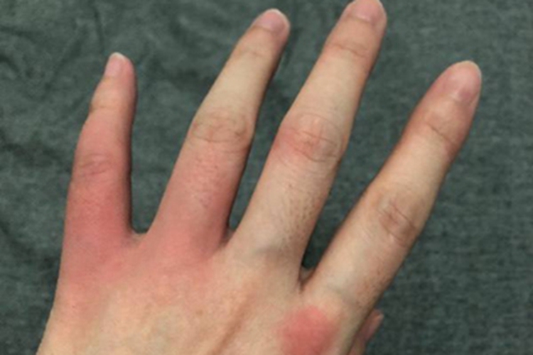 皮肤蝇蛆病手指红肿图 皮肤蝇蛆病手指红肿图