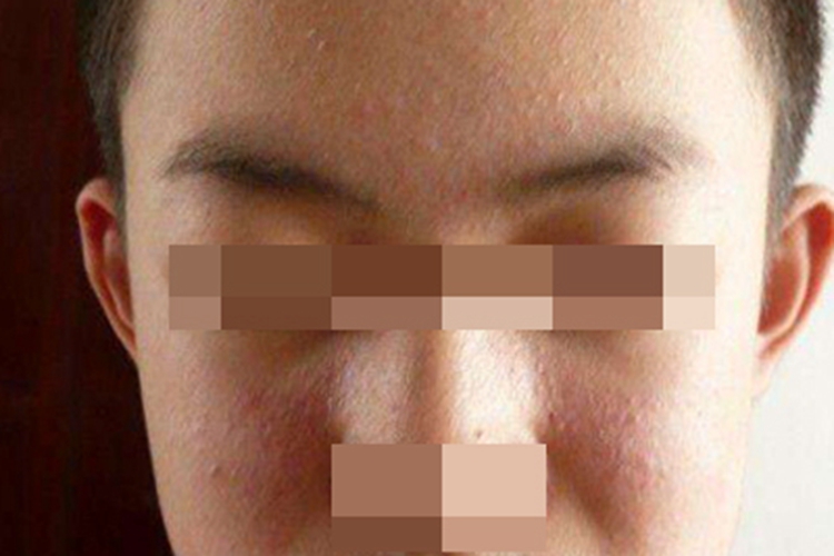 儿童丘疹性肢端皮炎面部症状图