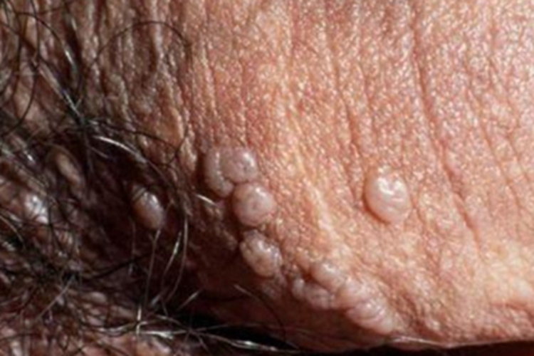鲍温样丘疹病小疙瘩图 鲍温样丘疹病小疙瘩图
