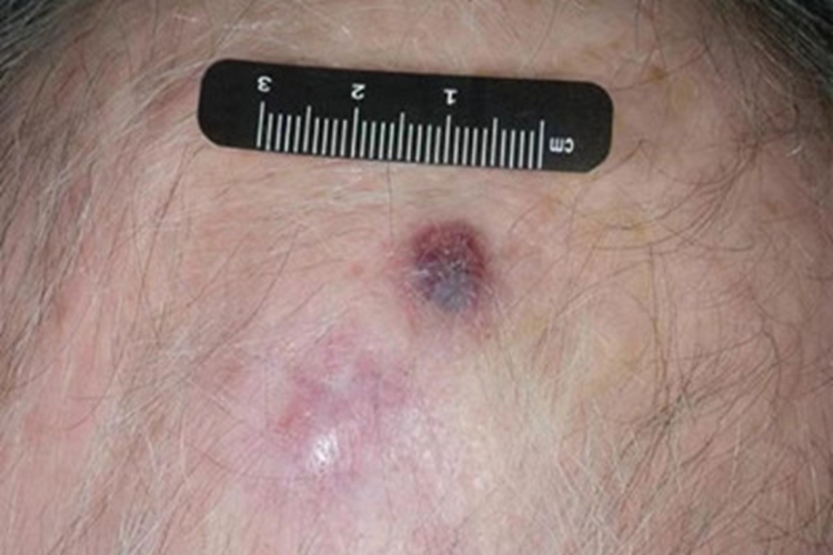 特发性头颈部血管肉瘤紫斑图 特发性头颈部血管肉瘤紫斑图