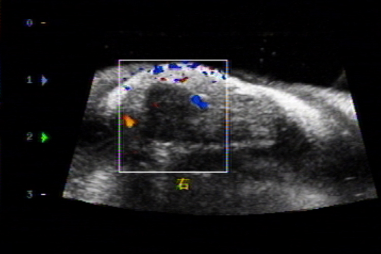 手指关节腱鞘炎超声图