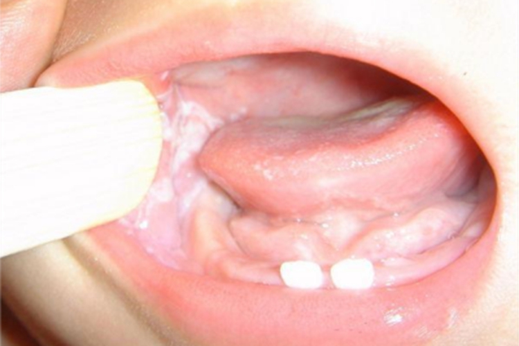 均质型口腔黏膜白斑斑块型白点图