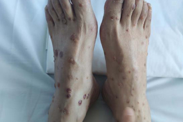 蚊虫叮咬结痂图 蚊虫叮咬结痂图